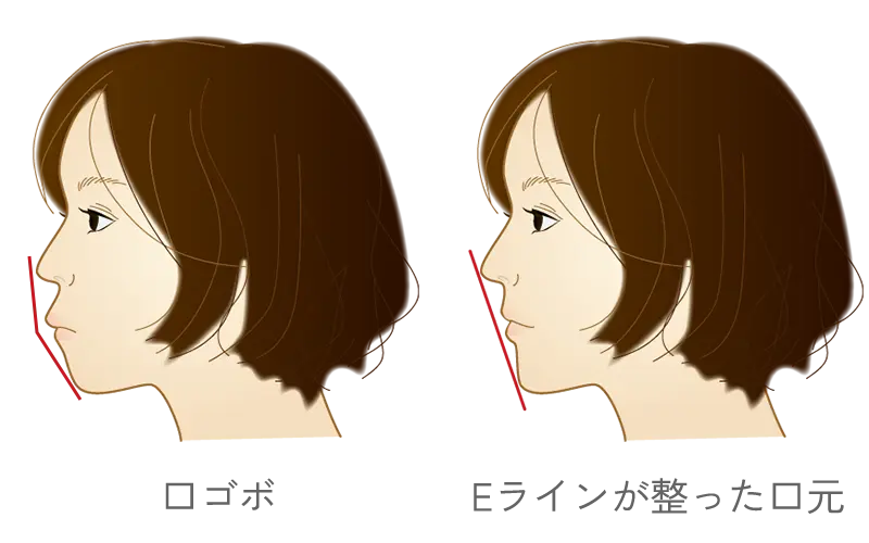 口ゴボ