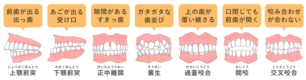 悪い歯並び