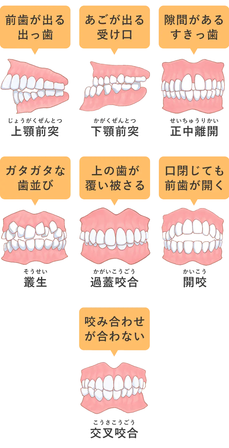 悪い歯並び